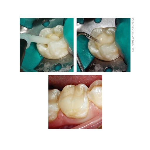 HyperFIL Bulk-Fill Composite (Enamel Shade - A1/B1) | S323 | | Composites including resins & hybrids, Cosmetic dentistry products, Dental, Dental Supplies | Parkell | SurgiMac