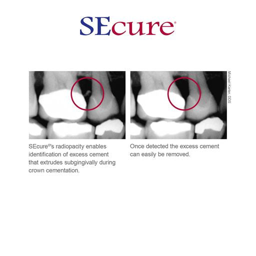 SEcure Resin Cement System | S270 | | Cosmetic Dentistry, Dental, Dental Supplies | Parkell | SurgiMac